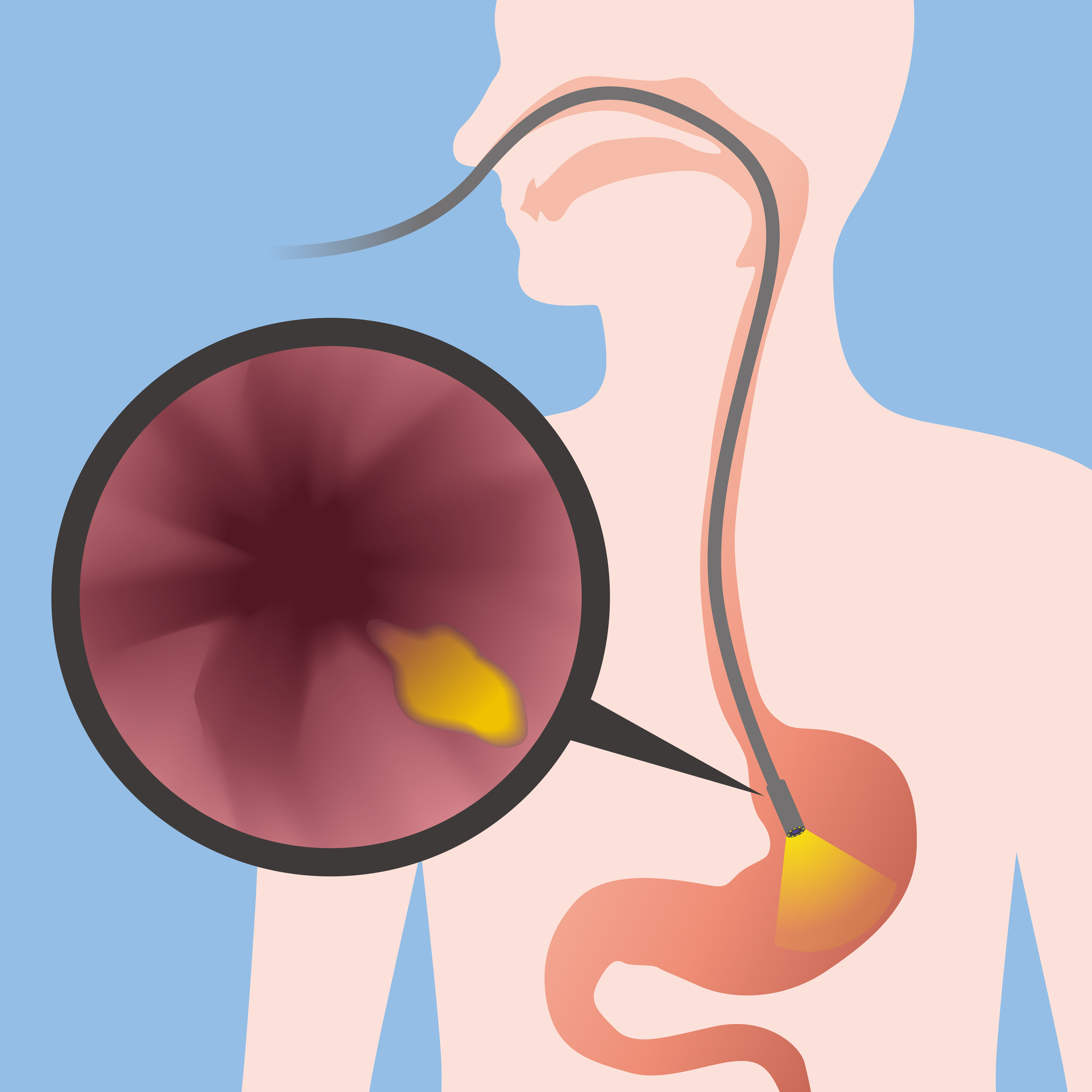 transnasal-esophagoscopy-alamo-ent-associates